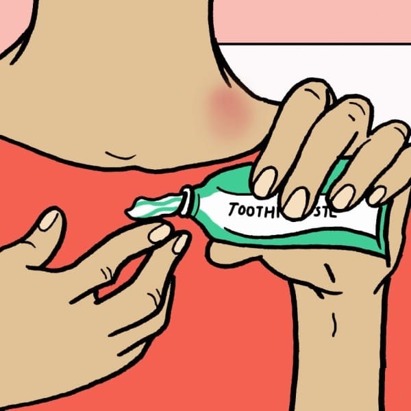 how to get rid of a hickey